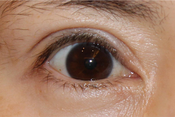 眼瞼下垂手術後の修正手術 オキュロフェイシャルクリニック東京