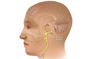 顔面神経麻痺