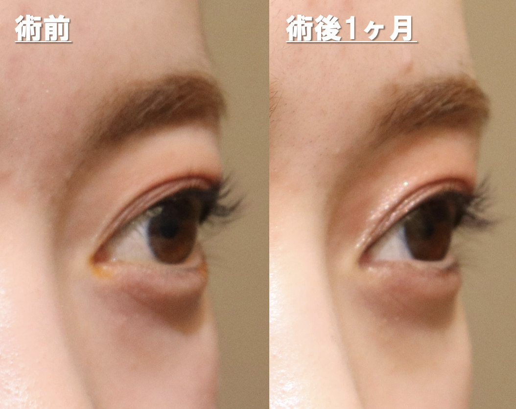 減圧術 出目修正 オキュロフェイシャルクリニック東京 世界最先端の眼形成手術