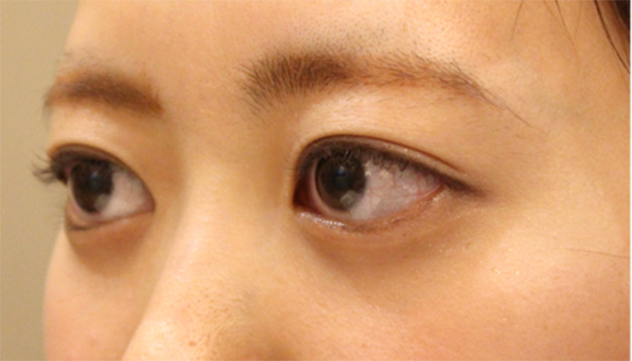 減圧術 出目修正 オキュロフェイシャルクリニック東京 世界最先端の眼形成手術