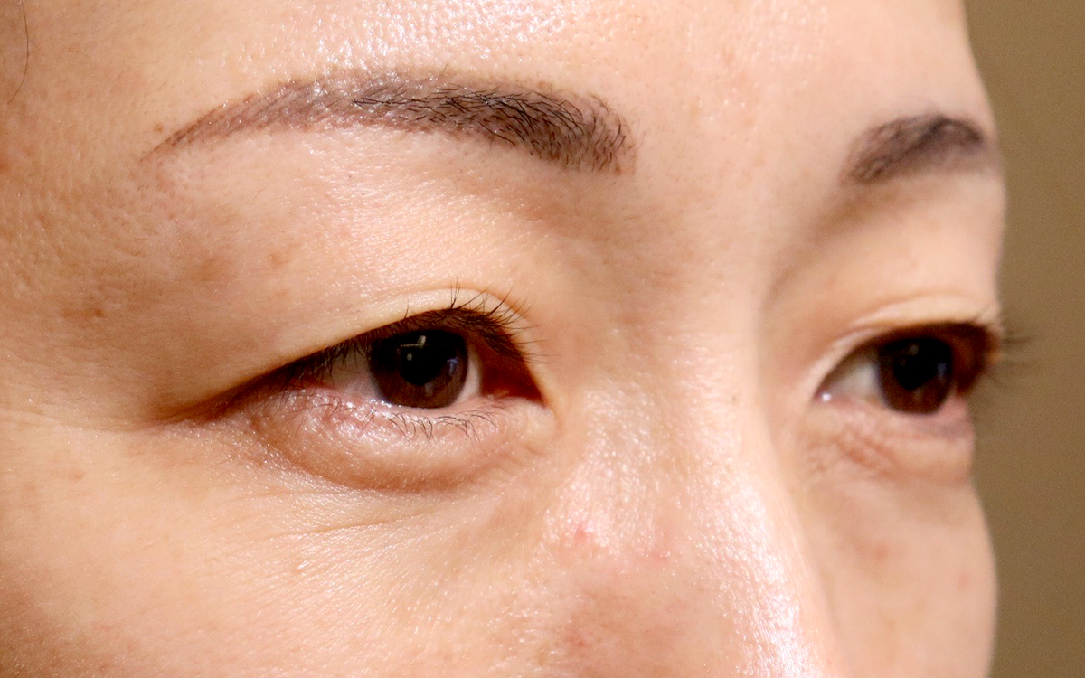 眼瞼下垂手術の症例 術後