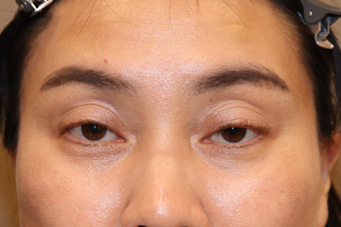 眼瞼下垂手術の症例 術前