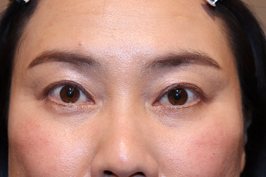 眼瞼下垂手術の症例 術後