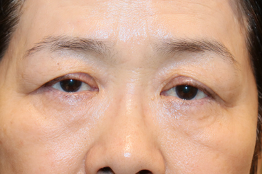 眼瞼下垂手術の症例 術前