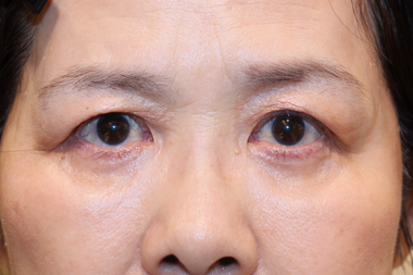 眼瞼下垂手術の症例 術後
