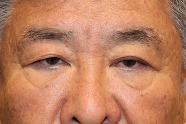 眼瞼下垂手術の症例 術前