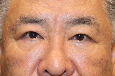 眼瞼下垂手術の症例 術後