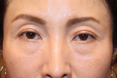 眼瞼下垂手術の症例 術前