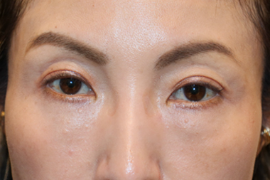 眼瞼下垂手術の症例 術後