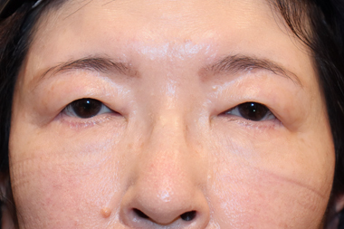 眼瞼下垂手術の症例 術前