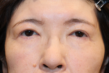 眼瞼下垂手術の症例 術後