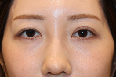 眼瞼下垂手術の症例 術前