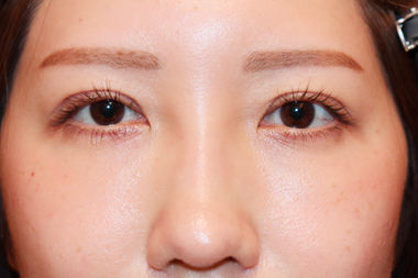 眼瞼下垂手術の症例 術後