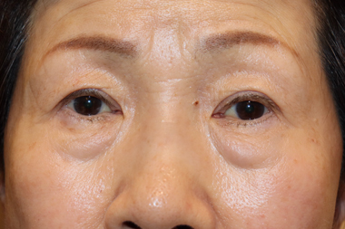眼瞼下垂手術の症例 術前