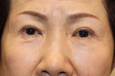 眼瞼下垂手術の症例 術後