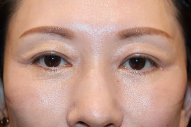 眼瞼下垂手術の症例 術前