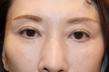 眼瞼下垂手術の症例 術後