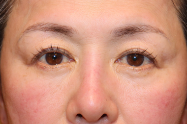 眼瞼下垂手術の症例 術前