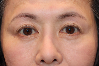 眼瞼下垂手術の症例 術後