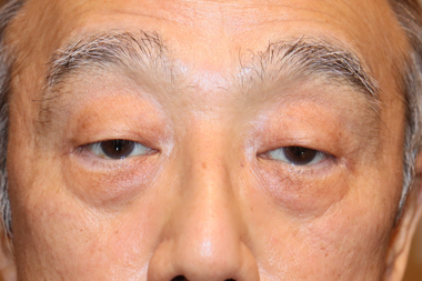眼瞼下垂手術の症例 術前