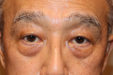 眼瞼下垂手術の症例 術後