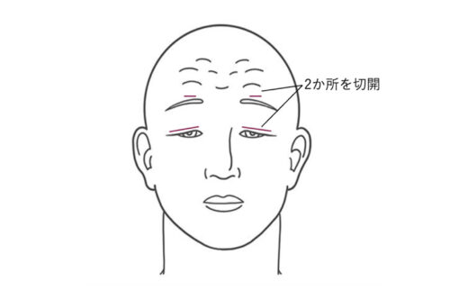 前頭筋吊り上げ術