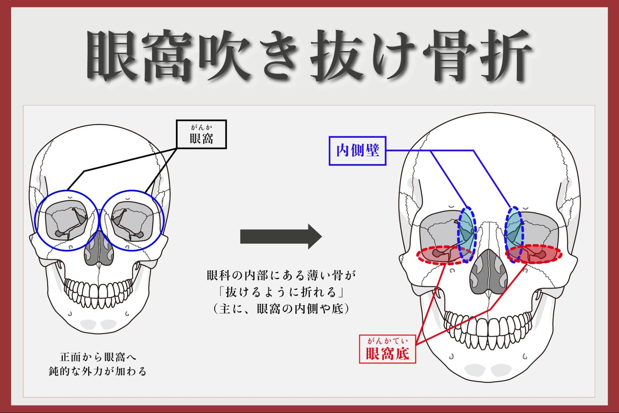 眼窩吹き抜け骨折