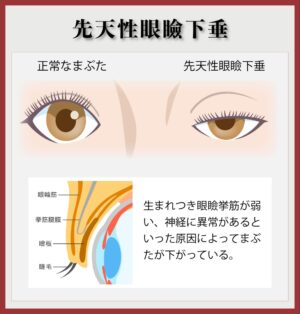 先天性眼瞼下垂