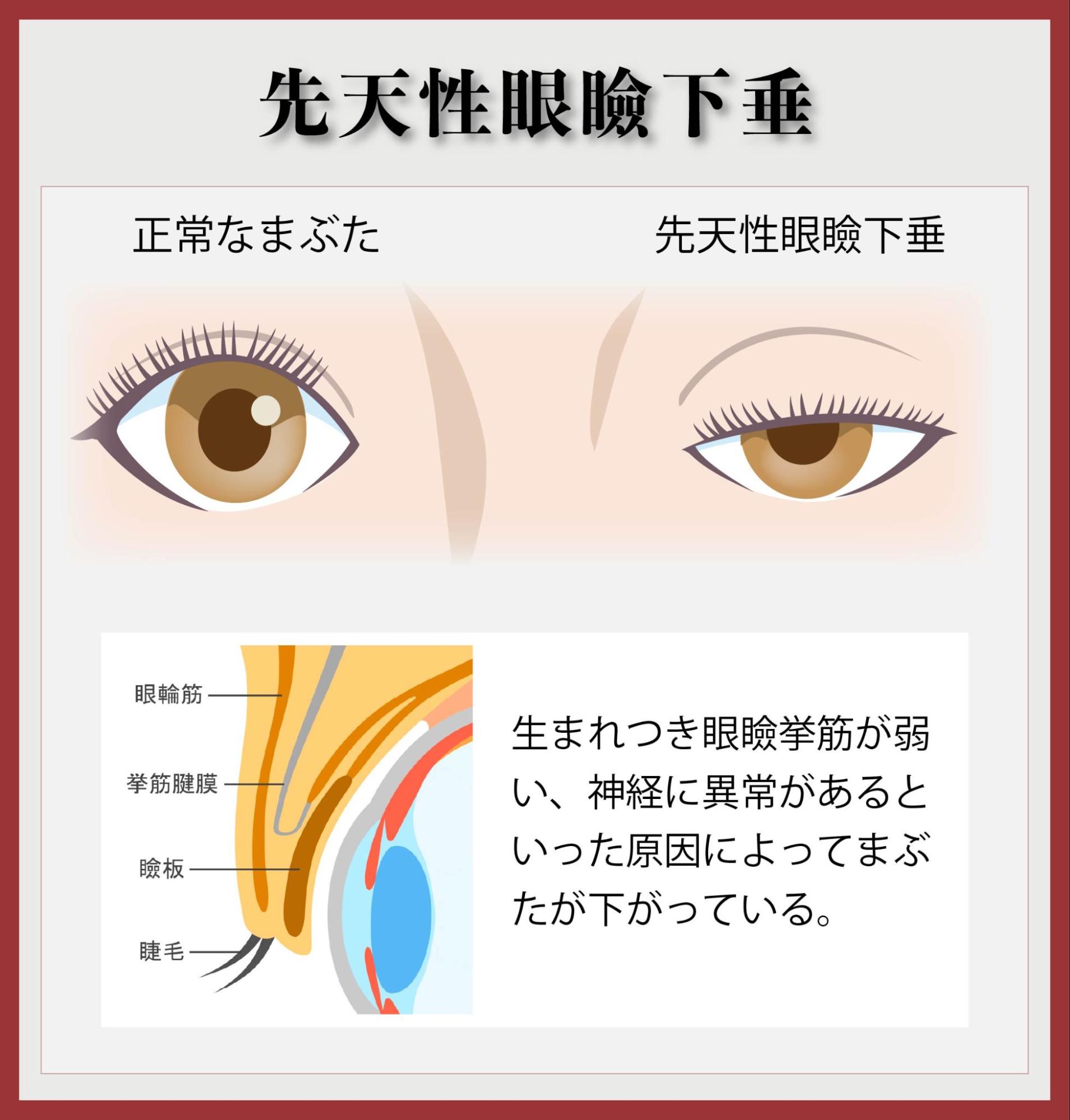 先天性眼瞼下垂