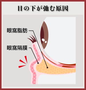 目の下のたるみの原因