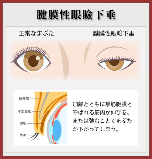 筋膜性眼瞼下垂