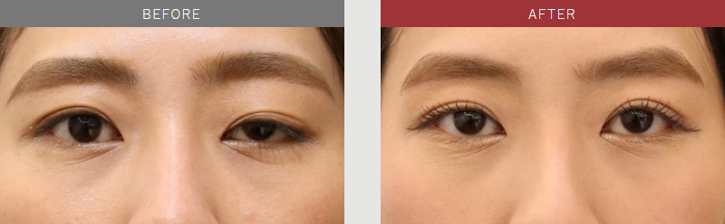 先天性眼瞼下垂