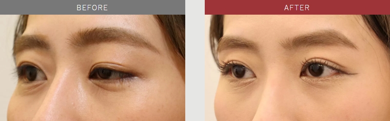 先天性眼瞼下垂