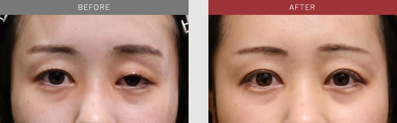 先天性眼瞼下垂